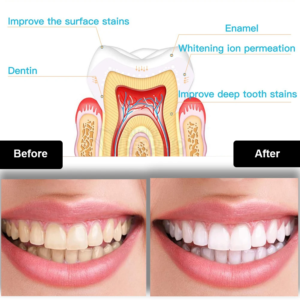 Dental Teeth Whitening Kit Min - đánh giá và giá Teeth Whitening Near Me